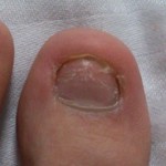 爪白癬(爪水虫) 治療体験記 【133日目】 &ndash; 治療とHP開設した理由