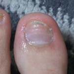 爪白癬(爪水虫) 治療体験記 【151日目】 &ndash; 5ヶ月経過！
