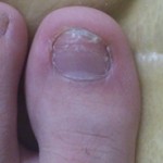 爪白癬(爪水虫) 治療体験記 【154日目】 – 白い爪が＾＾