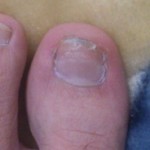 爪白癬(爪水虫) 治療体験記 【168日目】 – 水虫のかゆみ