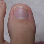爪白癬(爪水虫) 治療体験記 【197日目】 – これにて閉幕