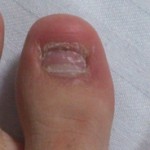 爪白癬(爪水虫) 治療体験記 【48日目】 &ndash; ラシミール
