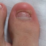 爪白癬(爪水虫) 治療体験記 【66日目】 &ndash; 爪の伸び方