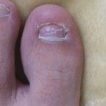 爪白癬(爪水虫) 治療体験記 【76日目】 &ndash; 爪水虫を逆浸食