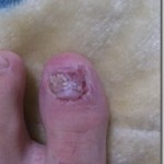 爪白癬(爪水虫) 治療体験記 【8日目】 – 爪剥がし