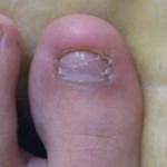 爪白癬(爪水虫) 治療体験記 【118日目】 &ndash; (約)4ヶ月経過！