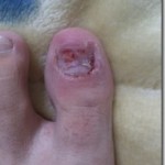 爪白癬(爪水虫) 治療体験記 【9日目】 – 続・爪剥がし