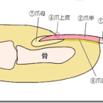 爪白癬(爪水虫) 治療体験記 【3日目】 – 試合開始